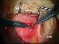 Trabeculectomy Limbus Based Flap