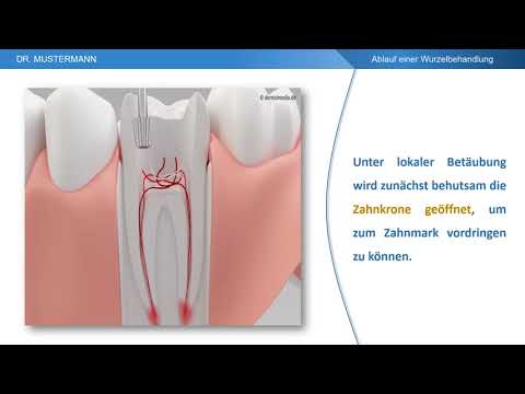 Ablauf der Behandlung - Wurzelbehandlung