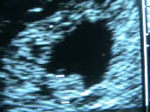 Transvaginal Ultrasound Pregnancy7.0週間-- Ultrasonido transvaginal Embarazo7.0semanas