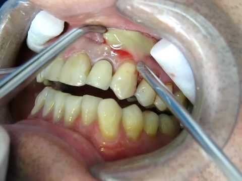 how to drain tooth abscess at home