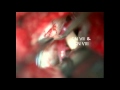 Hemifacial Spasm Treatment By Decompression Sling Swing Technique Hemifacial Spasm Treatment By Decompression Sling Swing Technique