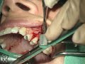 Large Maxillary Molar Restoration Part 1 Implant Placement