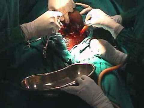 how to fasten natural miscarriage