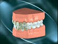 CARIES DENTAL