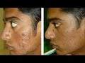 Acne Dermatology Treatment 101 Philadelphia Seema Patel MD Acne Dermatology Treatment 101 Philadelphia Seema Patel MD