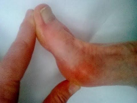 how to cure bunions
