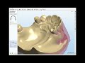 Removable Partial Framework Design 4 - NEW 2010