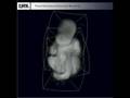 Medical Imaging: Three-Dimensional Ultrasound Mosaicing