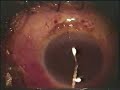 RELEASABLE SUTURES (5)