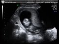 First Trimester