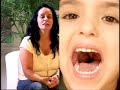 Tonsils & Adenoids - Airway Obstruction - Hearing Loss 50%