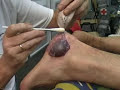 De mooiste blaar van de 4Daagse 2007. The biggest blister. De mooiste blaar van de 4Daagse 2007. The biggest blister.