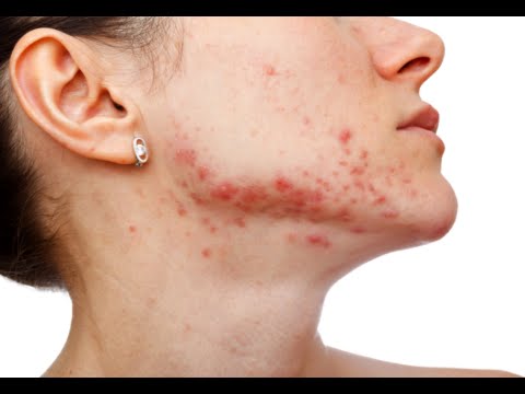 how to reduce pimples