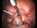 laparoscopic radical treatment of ectopic pregnancy