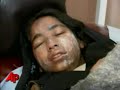 two girls are hospitalized with serious burns after two men on a motorbike threw acid on a group of girls walking to school in southern afghanistan. warning: some viewers may find this graphic video disturbing. (nov. 13)