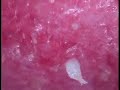 Comedone Extraction Comedone Extraction