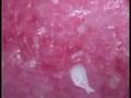 Comedone Extraction