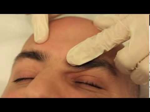 how to get rid of sebaceous hyperplasia