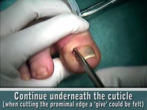 how to treat ingrown toenail