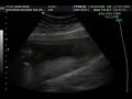 Ultrassom morfol�fico do baby com 22 semanas