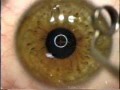 Lasik Eye Surgery Lasik Eye Surgery