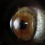 LASIK Patrick's Eye Surgery LASIK Patrick's Eye Surgery