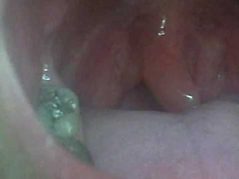 how to relieve a swollen uvula