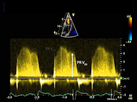 how to treat isolated diastolic hypertension