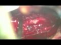Minimally invasive lumbar intradural extramedullary tumor resection
