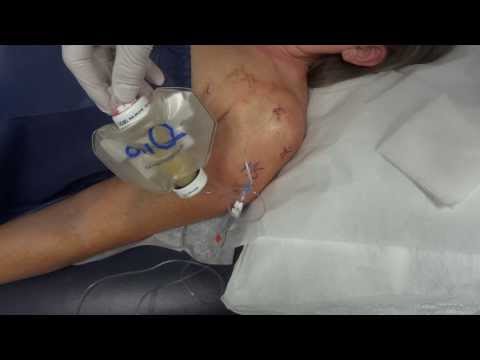 how to remove on q pain pump