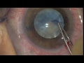 Gene Gullingsrud, MD Vision Blue Surprise