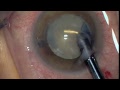 Gene Gullingsrud, MD Vision Blue Surprise