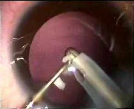 Surgery in congenital cataract with PCCC