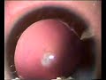 Surgery in congenital cataract with PCCC