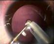 Surgery in congenital cataract with PCCC
