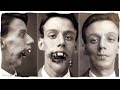 harold gillies biography harold gillies biography