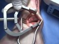 Lapidus Medial Approach Technique.m4v