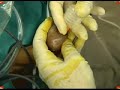 Dres Saenz de Cabezon,conocida saga de cirujanos urólogos, en este video nos muestran la eliminación de un tumor vesical con técnicas endoscópicas.Ambos viven en Barcelona