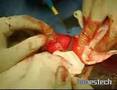 Fractura de Pene. Realizada por Dr. Arturo Portillo Castillo