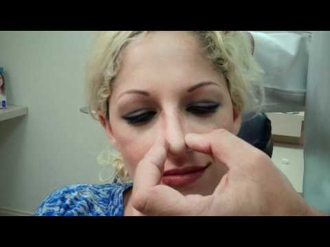 how to properly massage nose after rhinoplasty