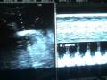 videos de EMBARAZO 38.6 SEMANAS-PREGNANCY 38.6 WEEKS - IT´S A BOY