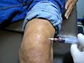 ACL injury knee aspiration ???????? ??????????????????????