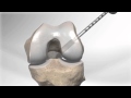 Click to View : All Inside ® ACL Reconstruction with GraftLink