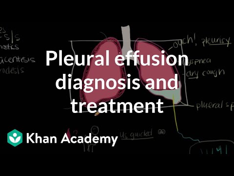 how to treat pleural effusion