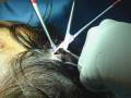 Rhinoplasty In the Operating Room - Deep Temporalis Fascia Harvest