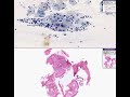 Histopathology Cervix-- High grade squamous intraepithelial