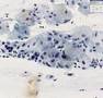 Histopathology Cervix-- High grade squamous intraepithelial