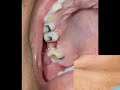FISTULA OROANTRAL