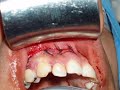 FISTULA OROANTRAL