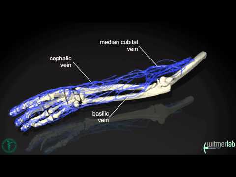 how to measure bleed in ct scan